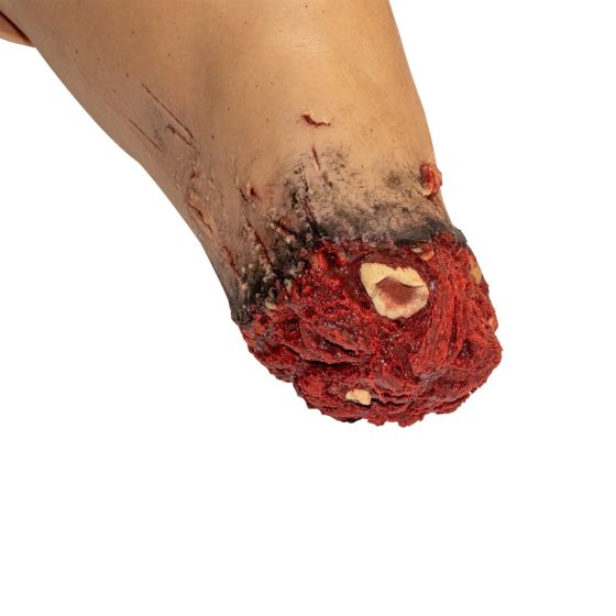 amputation wound